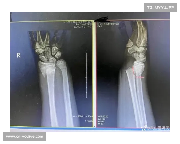 史密斯遭擂台暴力袭击后出院，上下颚创伤及颚骨骨折伤势严重